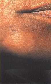 Os primeiros sinais da hanseníase são manchas na pele. Saiba como  identificá-las